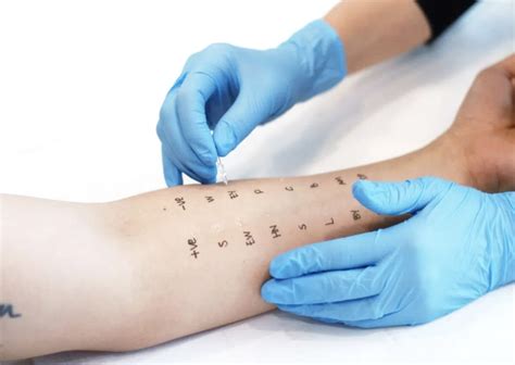 scratch test explanation|positive skin prick test.